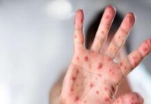 Meymunçiçəyi virusu yayılır: Azərbaycanda vəziyyət necədir?